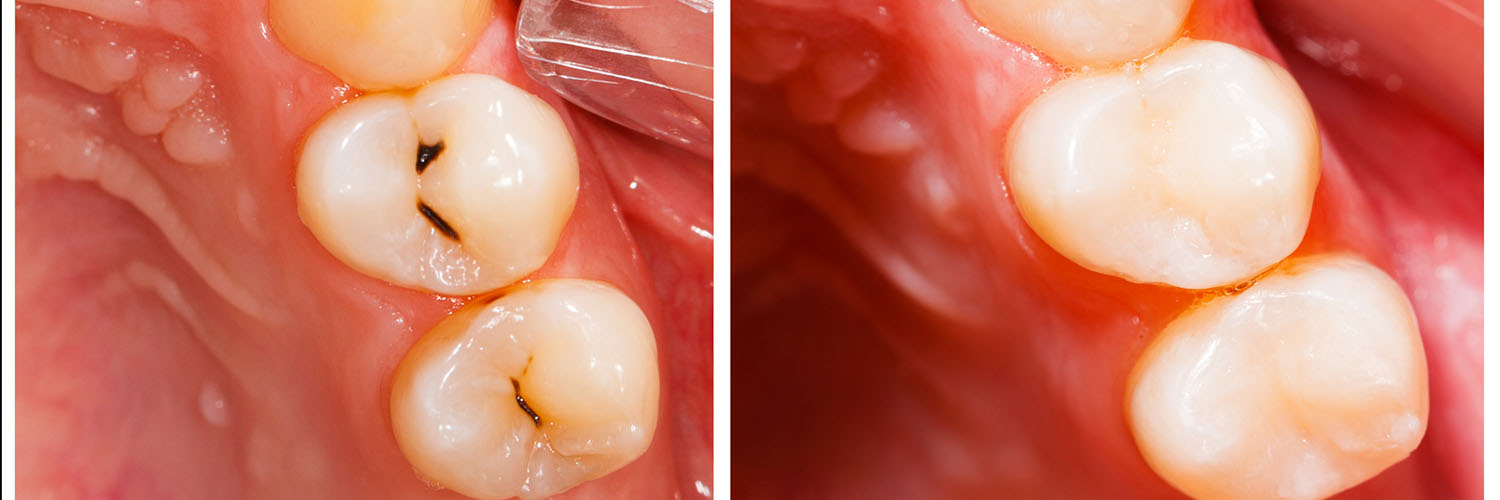 Summit Family Dentistry | Full Mouth Reconstruction, Root Canals and Fluoride Treatment